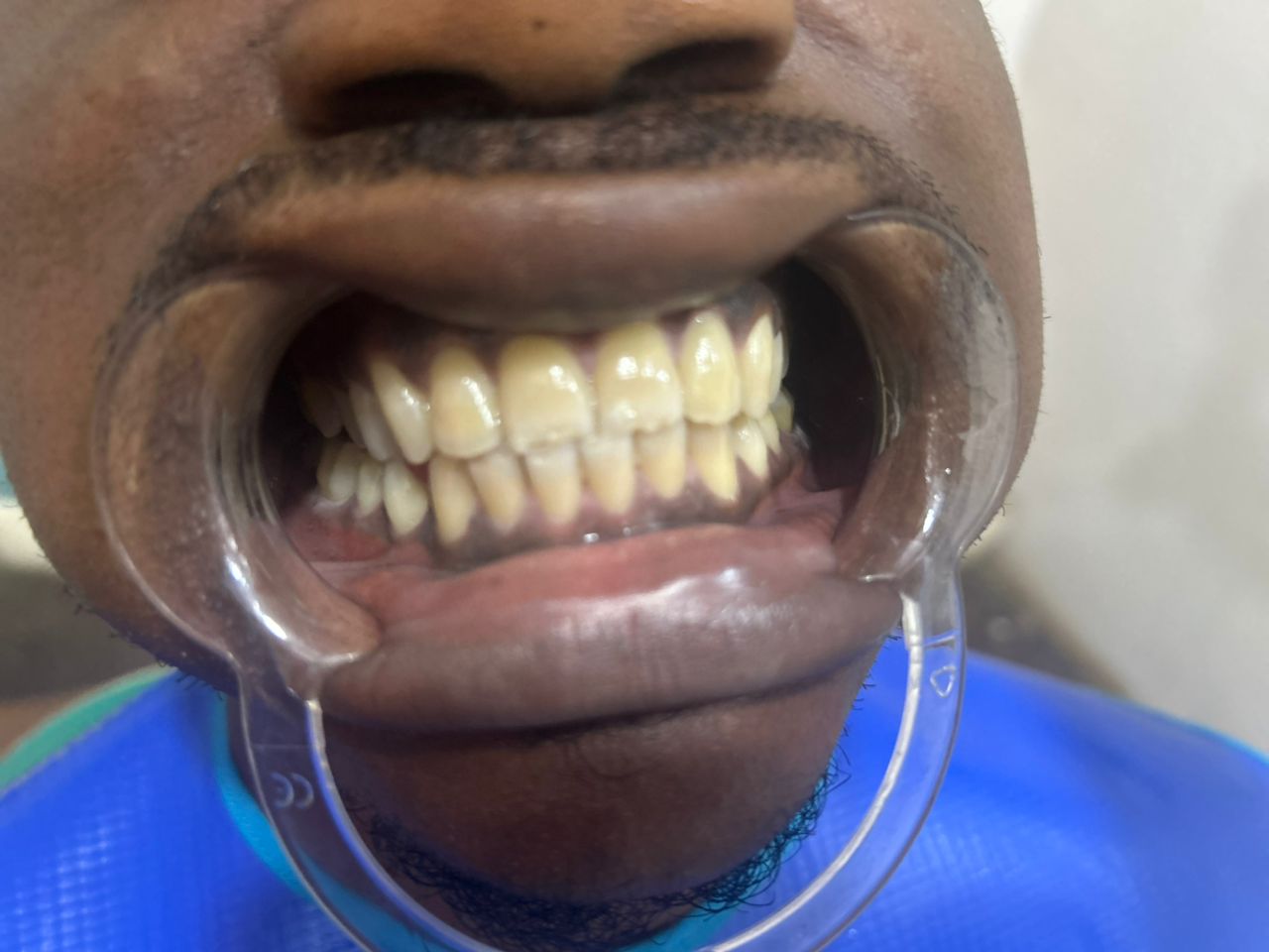Patient teeth before professional whitening treatment